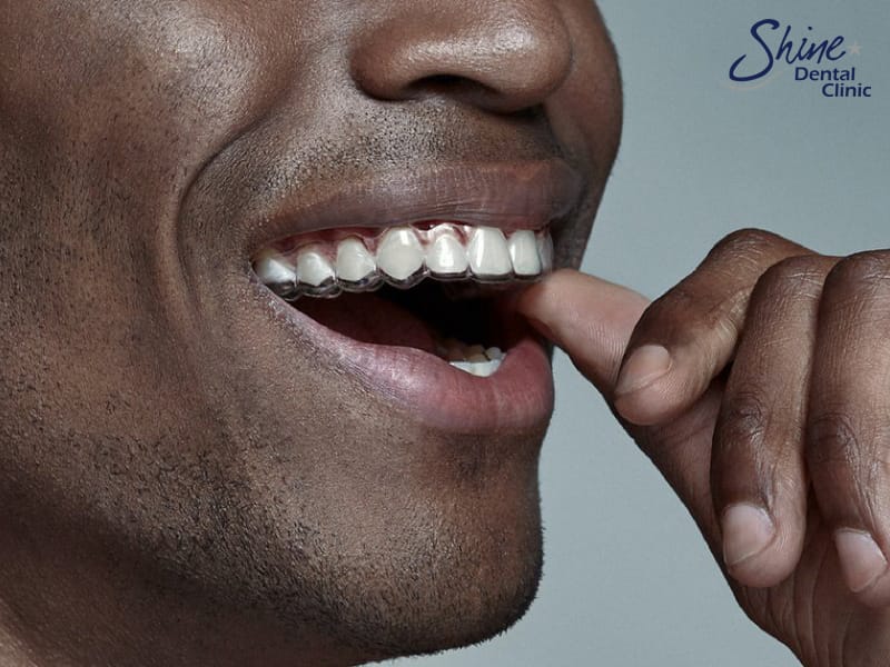 Adult orthodontics