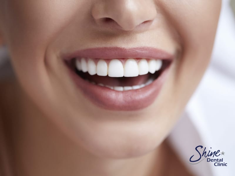 Composite vs Ceramic Veneers Dentist Alton